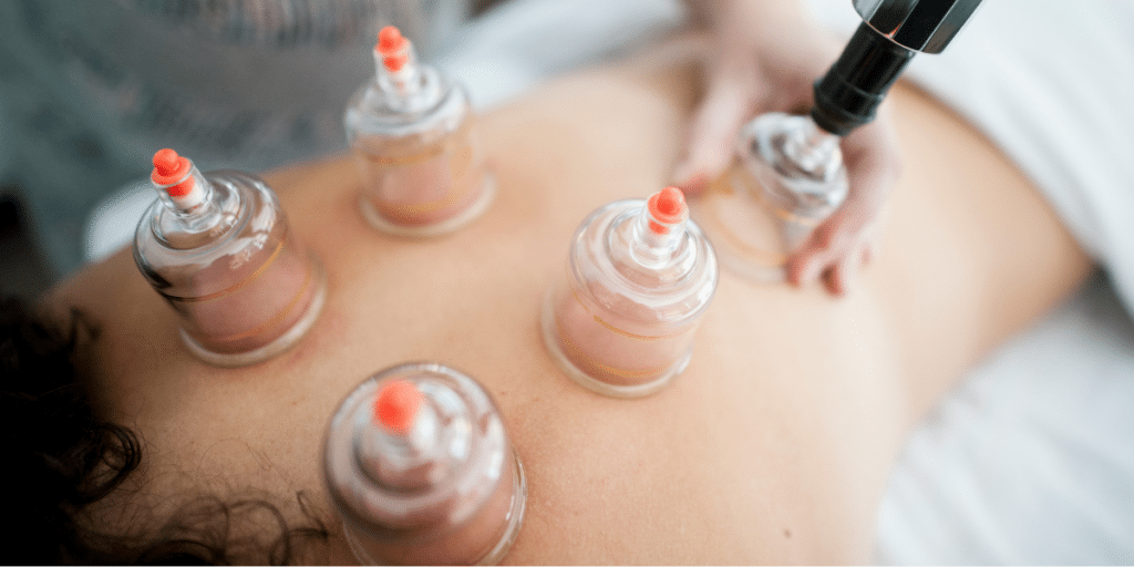 Cupping Therapy and Traditional Medicine Practices