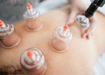 Cupping Therapy and Traditional Medicine Practices