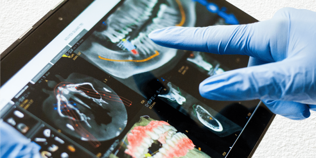 What Type of Dentist Does Implants? Understanding the Role of Implant Dentists
