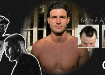 Gro Clinics Offers Hair Restoration Consultations