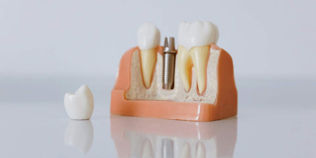 How to Prepare for Your First Dental Implant Procedure
