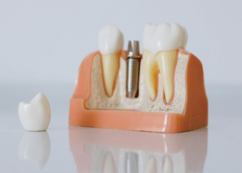 How to Prepare for Your First Dental Implant Procedure