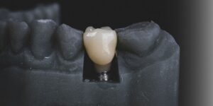 The Benefits of Dental Implants for Replacing Missing Teeth