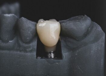 The Benefits of Dental Implants for Replacing Missing Teeth